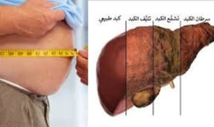 صورة مرض الكبد الدهني