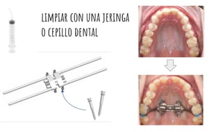 limpieza del expansor maxilar mse