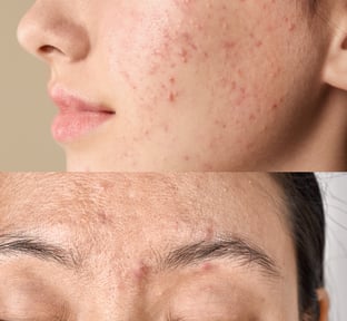 Acne and dark spots treatment
