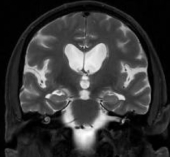Ressonância coronal do mesmo homem com hidrocefalia e dificuldade para andar.