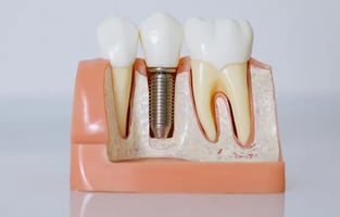 Mejores Implantes dentales en Sevilla
