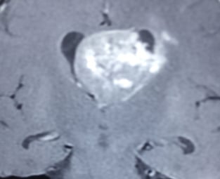 Tumor in the third ventricle- MRI BEFORE SURGERY