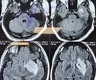 picture of insular glioma