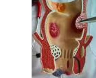 Analgesic properties: Honey relieves pain and itching associated with fissures and fistulas