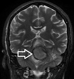 Ressonância coronal mostrando volumoso cavernoma (seta) na ponte (tronco encefálico).