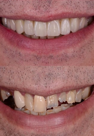 visse de cicatrisation implant