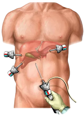 Laparoscopia para realizar colecistectomia