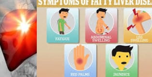 Liver Disease Can be caused by