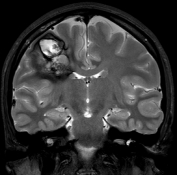 Cefaleia intensa e grande sangramento intracerebral antes da cirurgia no cérebro.