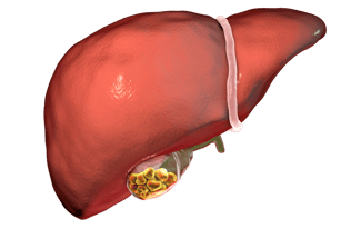 Gallstone Gallbladder stones Cholecystectomy