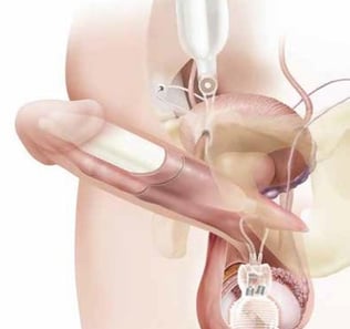 protesi peniena tricomponente