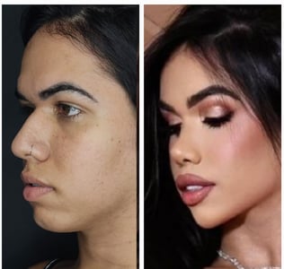 feminização facial frontoplastia