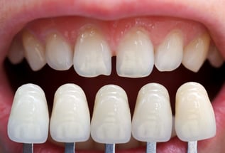 fatete dentare protetica coroane punte lucrare proteza