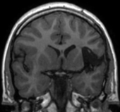 Ressonância após a cirurgia no cérebro e remoção total da displasia. Ele ficou livre da epilepsia.