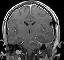 Ressonância corte coronal após a cirurgia no cérebro com a remoção total do cavernoma.