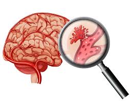 haemorrhage stroke IMAGE