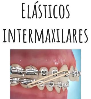 elásticos intermaxilares