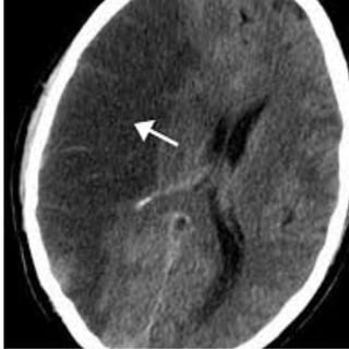 A stroke may damage the tissue that produces obstruction CSF or block the flow of CSF