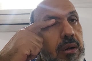 العسل فى العين