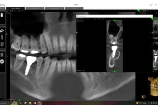 CBCT Scan 