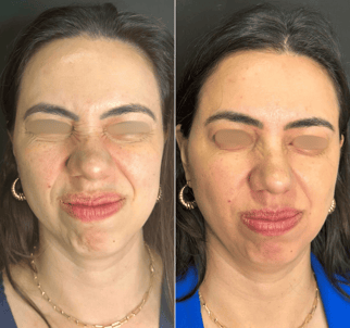 Botox-preenchimento-labial-bio-estimulador-de-colageno-em-pitanga-região-dra.-josiane