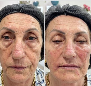 Botox-preenchimento-labial-bio-estimulador-de-colageno-em-pitanga-região-dra.-josiane