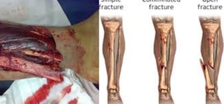 compound fracture