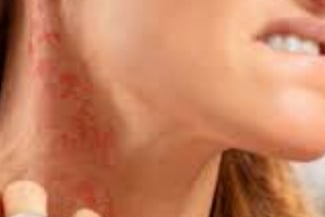 Fasting For Skin Allergies Itching & Pruritus