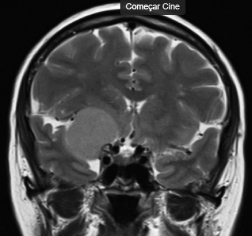 Ressonância de paciente com cefaleia e tumor petroclinoideo direito antes da cirurgia no cérebro.   