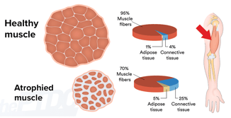 muscle atrophy