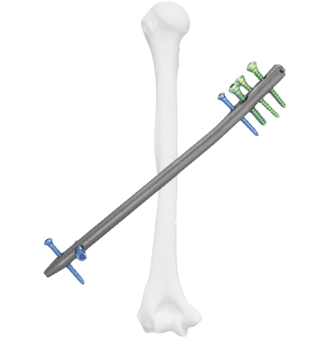 Clavo Intramedular para Húmero