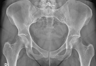 Pelvis Xray