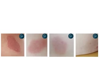 Eczéma