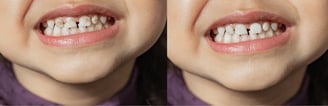 kids teeth