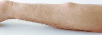 Lipoma Removal ray and rio's speciality clinic