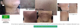 perifollicular-edema-after-LHR