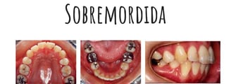 sobremordida