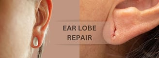 ray and rio's speciality Ear Lobe Repair: Restoring Confidence and Bringing Back Your Earring Dreams