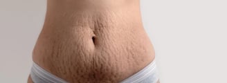 Stretch Marks ray and rio's speciality clinic