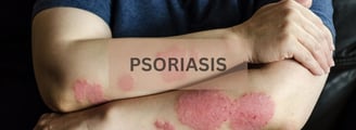 psoriasis treatment in chennai