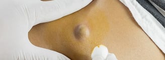 ​Sebaceous Cyst Removal ray and rio's speciality clinic