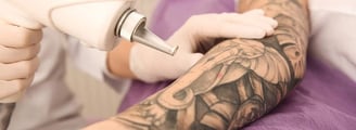 Laser Tattoo Removal ray and rio's speciality clinic