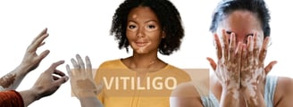 ray and rio's speciality clinic Vitiligo treatment