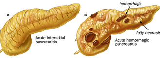 GASTRO FOUNDATION acute pancreatitis