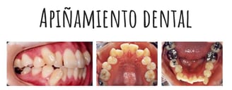 apiñamiento dental