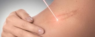 Laser Scar Revision ray and rio's speciality clinic