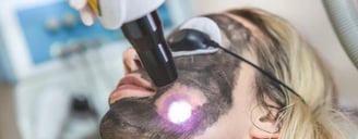 Carbon Laser Peel  ray and rio's speciality clinic