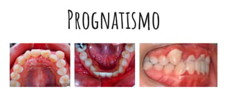 prognatismo mandibular