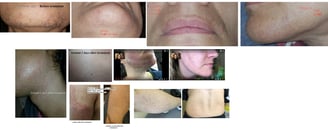 skin-after-electrology-treatment