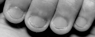 Bitten Nails